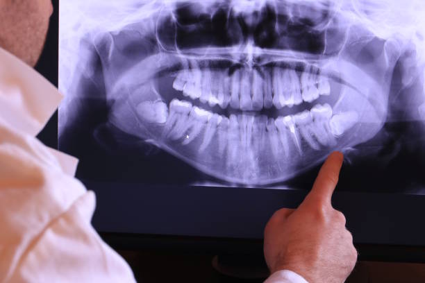 Best Emergency Wisdom Teeth Removal in Stanfield, OR